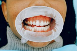 Read more about the article Can I Have All My Teeth Removed And Get Dentures?​
